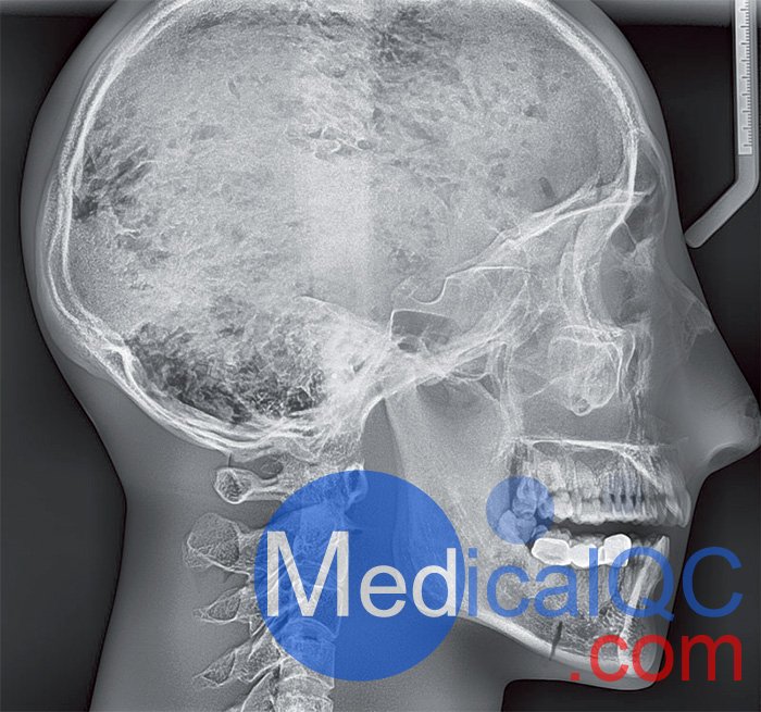 Erler Zimmer天然骨骼模體,Erler Zimmer頭部模體效果