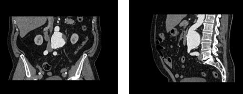 WEK53-05腹部模體，WEK53-05動脈瘤腹部模體，WEK53-05 CT血管造影模型成像